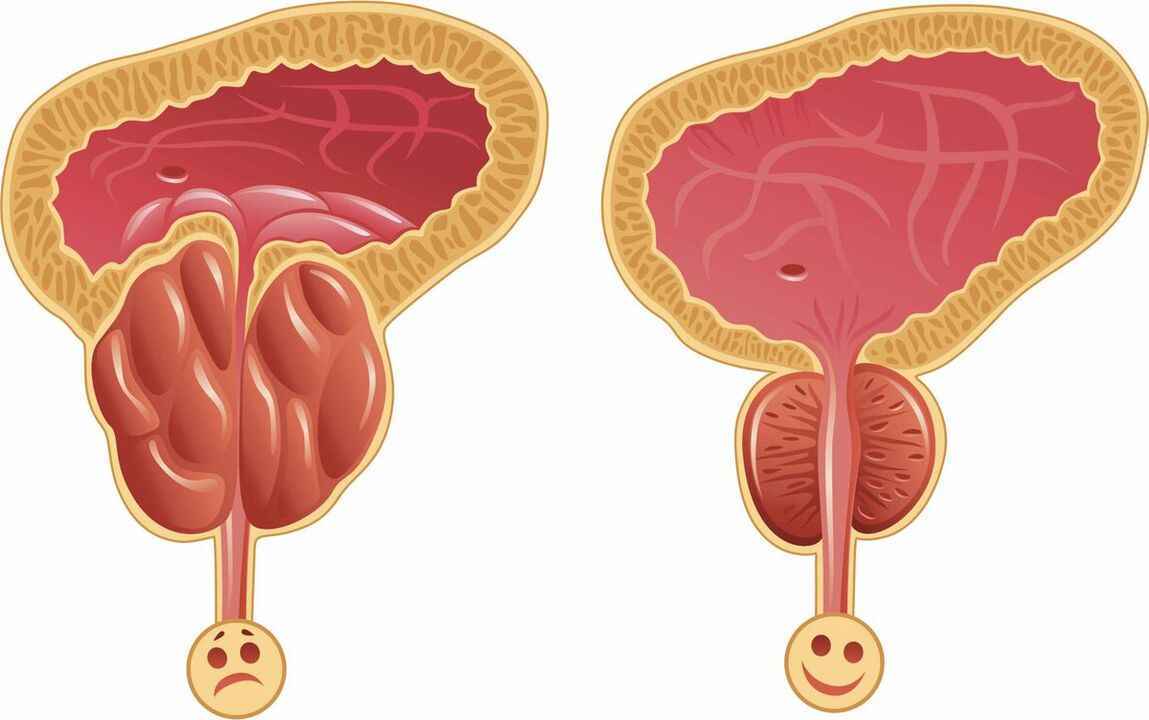 Prostata pred in po zdravljenju s kapsulami Prostaffect