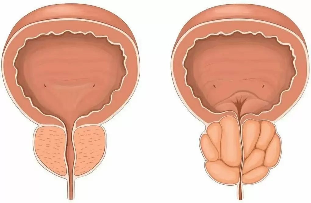 normalna prostata in bolna prostata